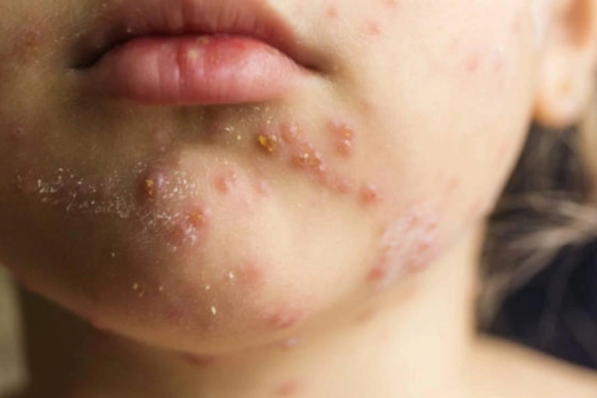 ABŞ-nin 12 ştatında qızılca yayılıb