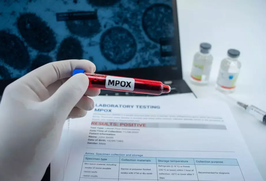 Britaniyada fövqəladə vəziyyət - Meymunçiçəyinə görə...